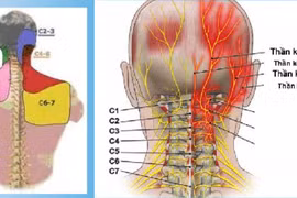 Đốt sống cao tần trị đau đầu xuất phát từ đốt sống cổ