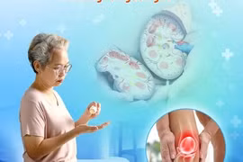 Cẩn thận thuốc xương khớp gia truyền gây suy tuyến thượng thận, trụy tim mạch