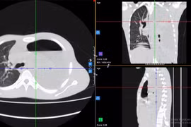 Kịp thời cứu sống lá phổi suýt bị “hủy hoại” do tràn mủ màng phổi phức tạp