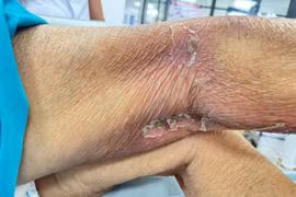 Cứu sống bệnh nhân ngừng tim, sốc nhiễm khuẩn do ong đốt hóa mủ