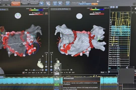 Chỉ 4 giây mỗi điểm đốt rung nhĩ giúp bệnh nhân giảm biến cố tim mạch