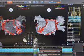 Chỉ 4 giây mỗi điểm đốt rung nhĩ giúp bệnh nhân giảm biến cố tim mạch