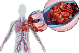 Người phụ nữ thuyên tắc mạch phổi nguy kịch sau mổ cắt tử cung