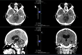 Liệt lưỡi do u não chèn ép thần kinh, bay từ Mỹ về Việt Nam giải cứu