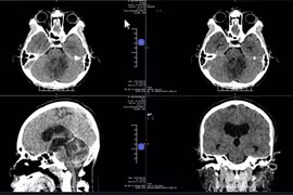 Liệt lưỡi do u não chèn ép thần kinh, bay từ Mỹ về Việt Nam giải cứu