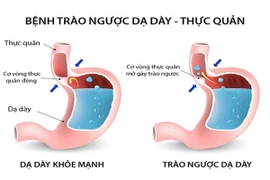 Thay đổi chế độ ăn uống chữa trào ngược dạ dày – thực quản