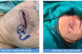 Khối u da bất thường vùng môi dưới không ngờ ung thư