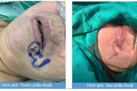 Khối u da bất thường vùng môi dưới không ngờ ung thư