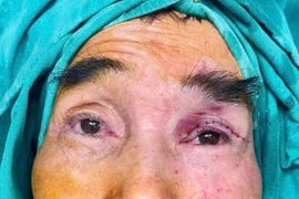 Tạo hình vạt cơ trán chữa mắt bị “che rèm” từ thuở lọt lòng ở cụ ông 65 tuổi