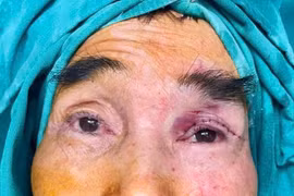 Tạo hình vạt cơ trán chữa mắt bị “che rèm” từ thuở lọt lòng ở cụ ông 65 tuổi