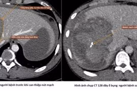 Nút mạch cứu sống người bệnh chấn thương gan nặng do tai nạn giao thông