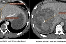 Nút mạch cứu sống người bệnh chấn thương gan nặng do tai nạn giao thông