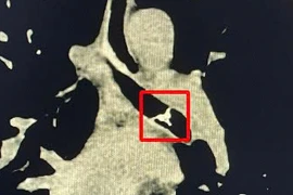 Suýt thủng phế quản vì mảnh xương cá đi lạc