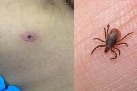 Sốt mò, bệnh truyền nhiễm, ấu trùng mò, suy tim, suy thận, suy hô hấp, sốt