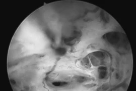 Giữ 'cái ngàn vàng', cô gái phát hiện ung thư niêm mạc tử cung muộn