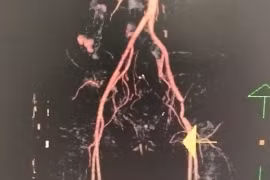 Cứu nguy chi thể tránh hoại tử, cắt cụt cho bệnh nhân bị thanh sắt đập bẹn