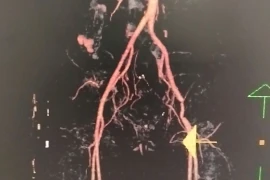 Cứu nguy chi thể tránh hoại tử, cắt cụt cho bệnh nhân bị thanh sắt đập bẹn