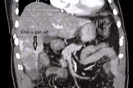 Đau hạ sườn 1 ngày, người đàn ông vỡ u gan nguy kịch