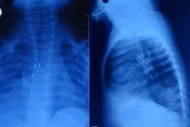 Cấp cứu bé 9 tháng tuổi sặc bóng đèn LED trong phế quản