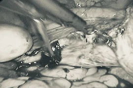 Nhiều năm không điều trị u xơ, người phụ nữ 44 tuổi phải cắt bán phần tử cung