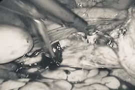 Nhiều năm không điều trị u xơ, người phụ nữ 44 tuổi phải cắt bán phần tử cung