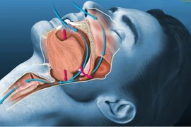 Ngưng thở khi ngủ dễ biến chứng tim mạch, cách gì phát hiện sớm?