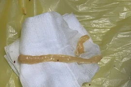 Sán dây gần 1 mét 'ngọ nguậy' trong đại tràng người đàn ông thích ăn đồ tái