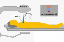 Đồng bộ nhịp thở, công nghệ xạ trị thông minh cho người bệnh ung thư