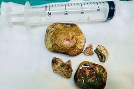 Lấy trọn khối sỏi bàng quang kích thước lớn cho người mang nhiều bệnh