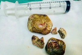 Lấy trọn khối sỏi bàng quang kích thước lớn cho người mang nhiều bệnh