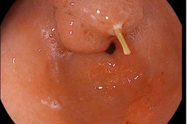 Sau 3 ngày nuốt tăm, bệnh nhân thủng dạ dày