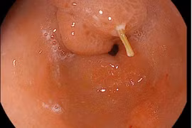 Sau 3 ngày nuốt tăm, bệnh nhân thủng dạ dày