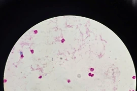 Ho sốt, đau đầu 2 ngày, người phụ nữ tại Hà Nội viêm não mô cầu nguy kịch