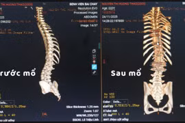 Thiếu nữ 20 tuổi vẹo cột sống nặng được trả lại hình dáng cân đối
