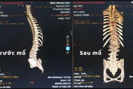 Thiếu nữ 20 tuổi vẹo cột sống nặng được trả lại hình dáng cân đối