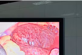 Cấp cứu thành công ca u nang buồng trứng xoắn ở trẻ 16 tuổi