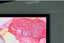 Cấp cứu thành công ca u nang buồng trứng xoắn ở trẻ 16 tuổi