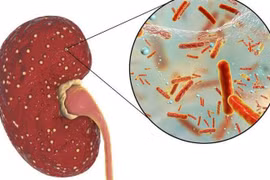 Điều trị kịp thời viêm thận, bể thận cấp trẻ em, ổ nung mủ sâu nguy hiểm