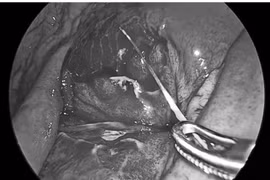 Phát hiện dị vật sau cơn đau bụng dữ dội, bệnh nhân viêm phúc mạc nguy hiểm