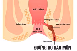 Chàng trai 25 tuổi đau đớn vì bệnh rò hậu môn nguy cơ ung thư