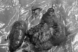 Đau vùng hạ sườn không ngờ phải cắt khối tá tụy do ung thư