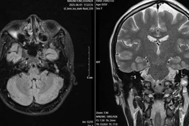 Lấy u, nối dây thần kinh chữa liệt mặt 10 năm cho người phụ nữ 35 tuổi