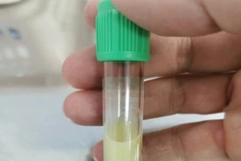 Viêm tụy cấp do không tuân thủ điều trị đái tháo đường