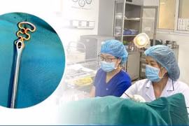 Bỏ quên vòng tránh thai 30 năm, bệnh nhân 63 tuổi gặp biến chứng phụ khoa