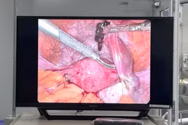 Cứu bệnh nhân 35 tuổi người Philippines vỡ thai ngoài tử cung nguy kịch