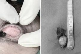 Phẫu thuật điều trị u bì kết giác mạc to trên mi người đàn ông 33 tuổi