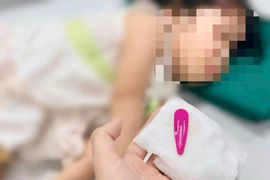 Gắp dị vật kẹp tóc dài 5cm trong dạ dày bé gái 21 tháng tuổi