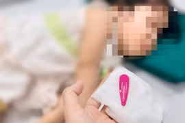 Gắp dị vật kẹp tóc dài 5cm trong dạ dày bé gái 21 tháng tuổi