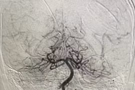 Hồi sinh bé trai nguy kịch do thuyên tắc mạch máu não