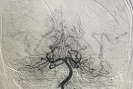 Hồi sinh bé trai nguy kịch do thuyên tắc mạch máu não
